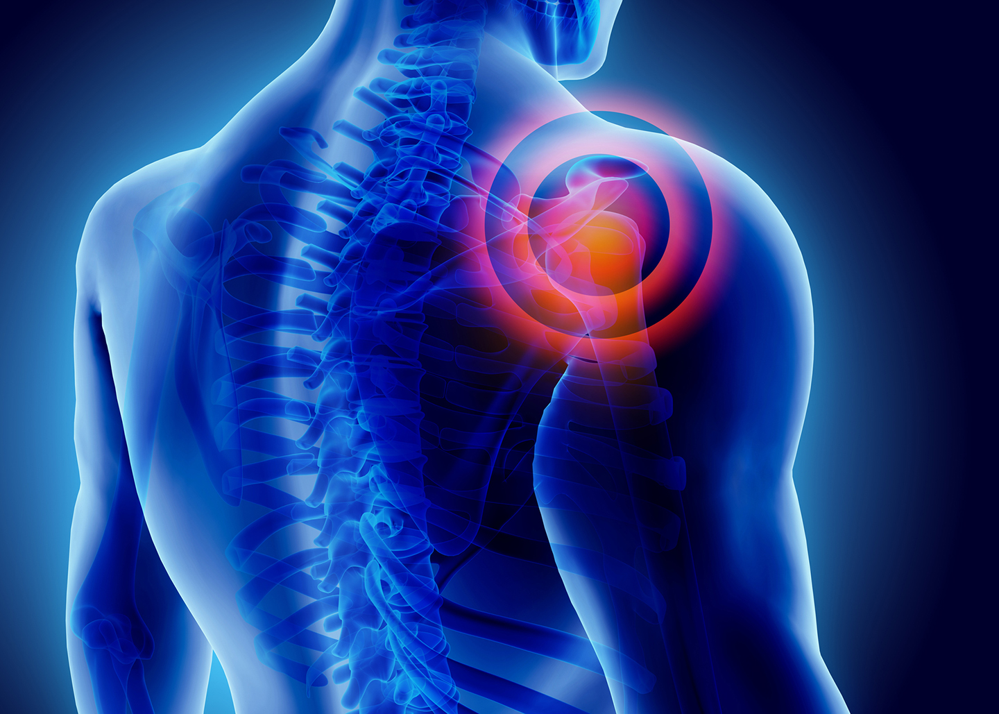 Frozen  Shoulder